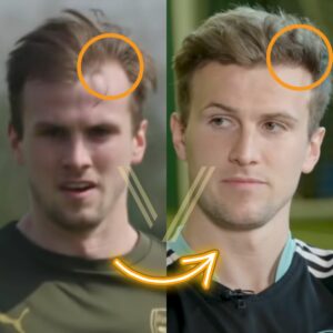 before after rob holding hair transplant 