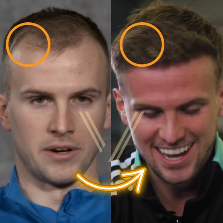 Rob Holding Hair Transplant