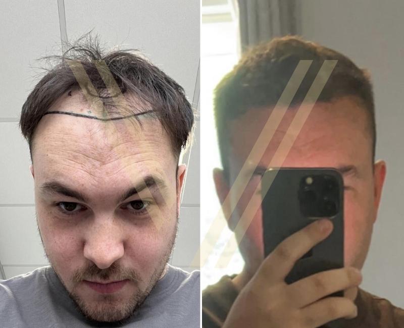 before and after photo of a pale male patient