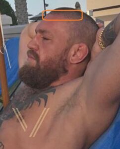 conor mcgregor hair hair transplant