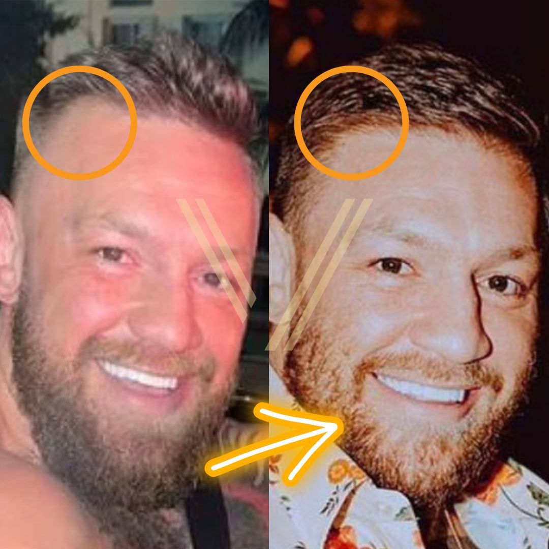 Conor Mcgregor S Hair Transplant Before And After Transformation