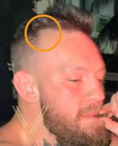 conor mcgregor hair loss