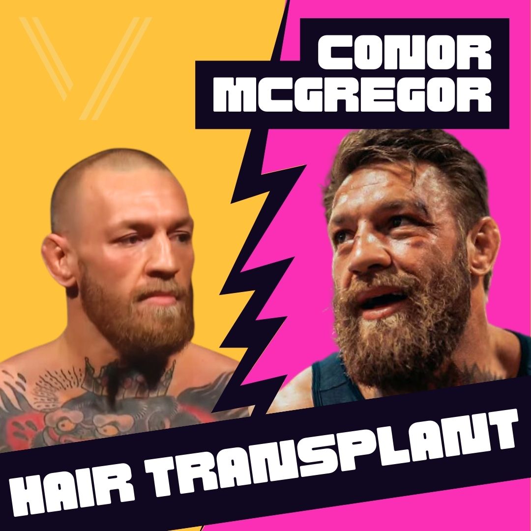 conor mcgregor hair transplant before after