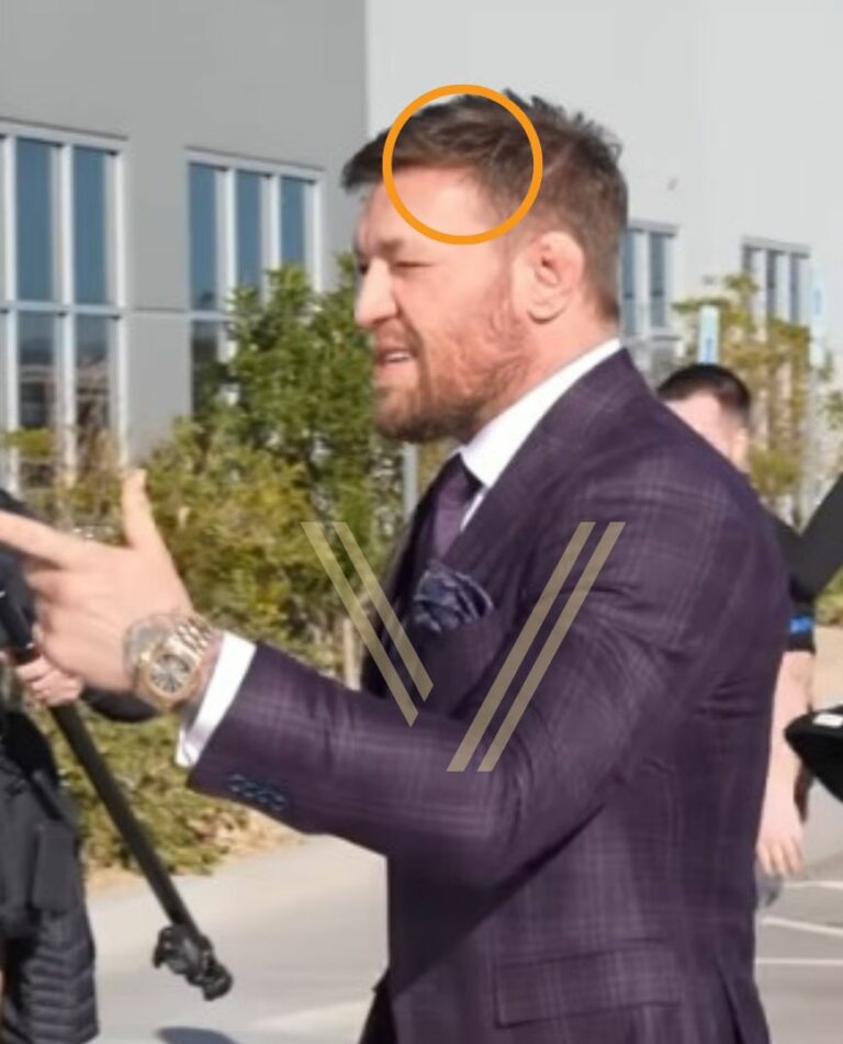 Conor McGregor's Hair Transplant: Before and After Transformation