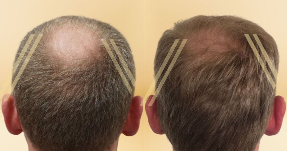 donor area and crown after hair transplant