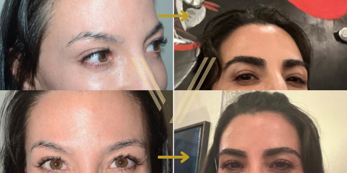 eyebrow transplant before and after result