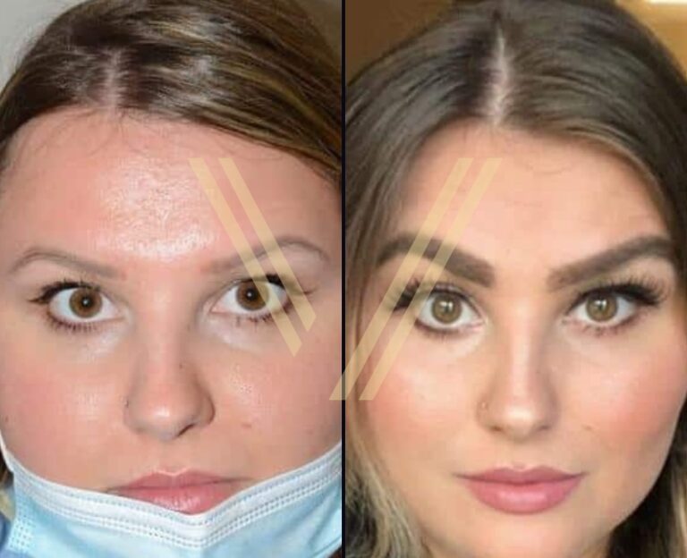 Eyebrow Transplant in Turkey