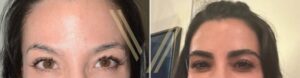 female-eyebrow-transplant-in-turkey-before-after-photo