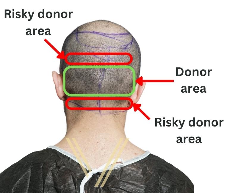 donor area interpretation on patient to explain how hair density may affect the procedure