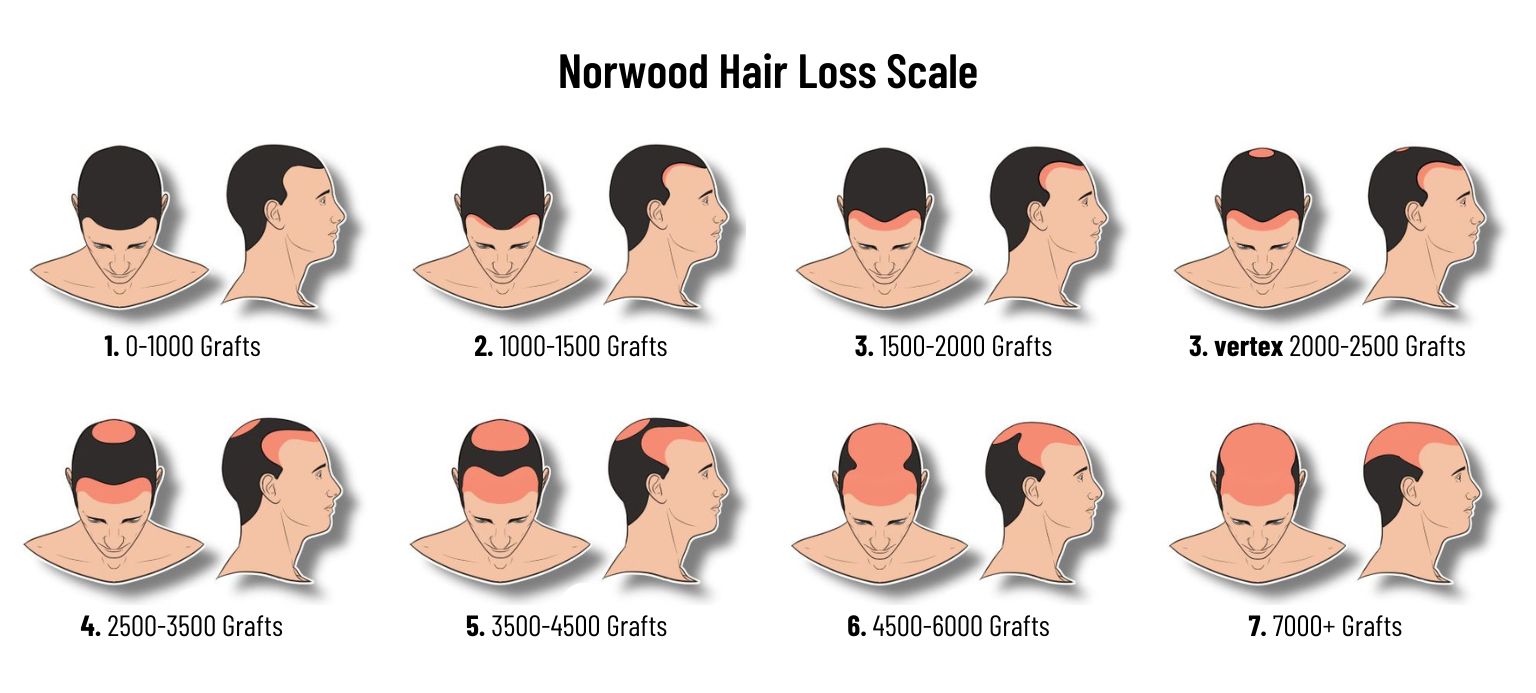 norwood hair loss scale 7 stages