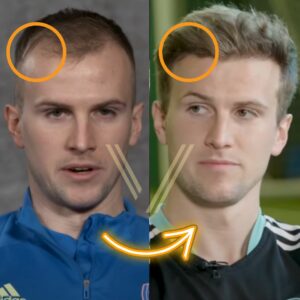 rob holding before after hair transplant