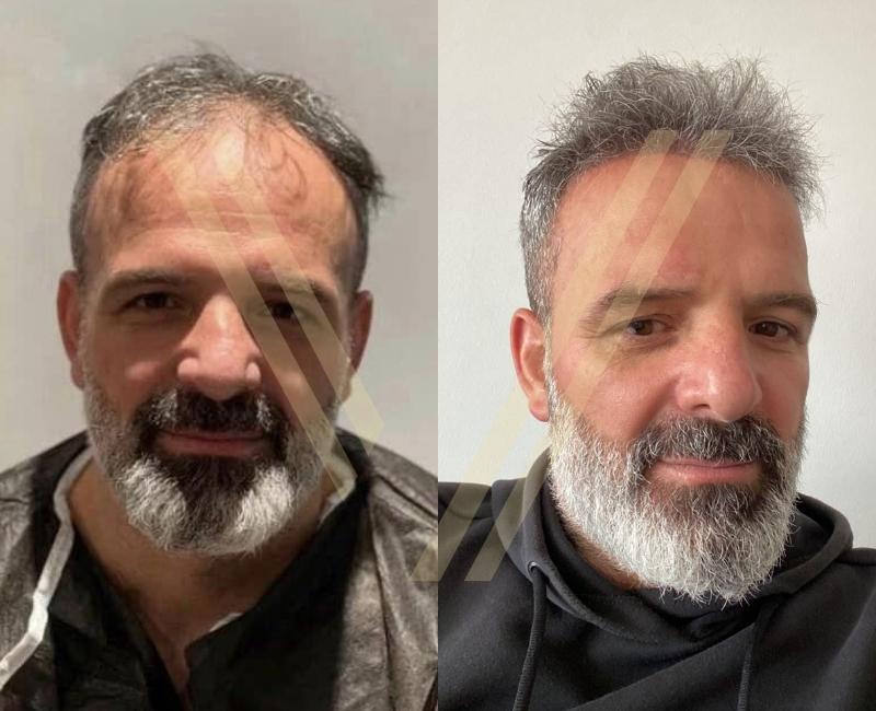 before after photo of a middle aged patient to interpret how to set up expectations on a hair transplant operation