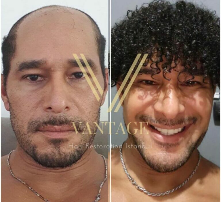 6000 grafts hair transplant before and after