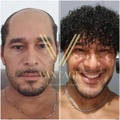6000 Grafts Hair Transplant in Turkey
