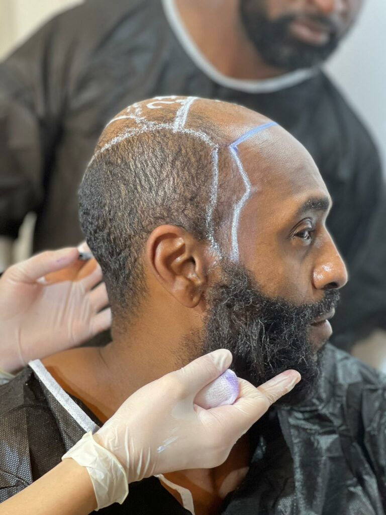 6000 grafts hair transplant before operation