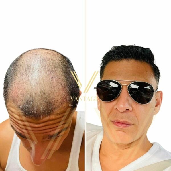 7000 grafts hair transplant before after