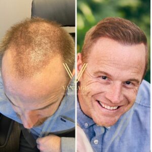 7000 grafts hair transplant before after result