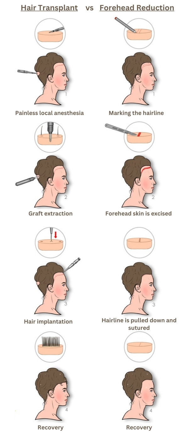 Hair transplant vs forehead reduction for hairline lowering