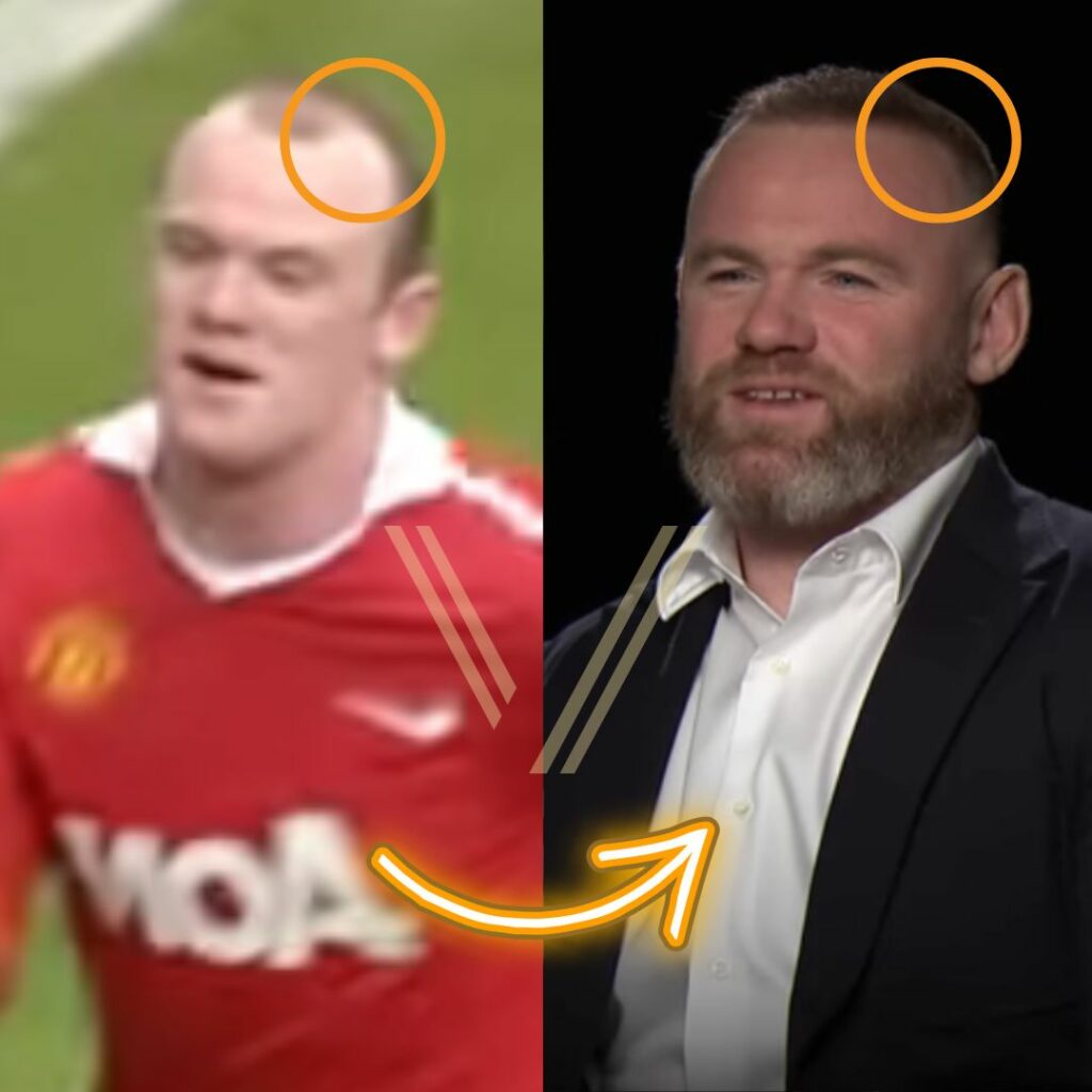 Wayne Rooneys Hair Transplant Before And After Transformation 2447