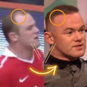 Wayne Rooney before after hair transplant result