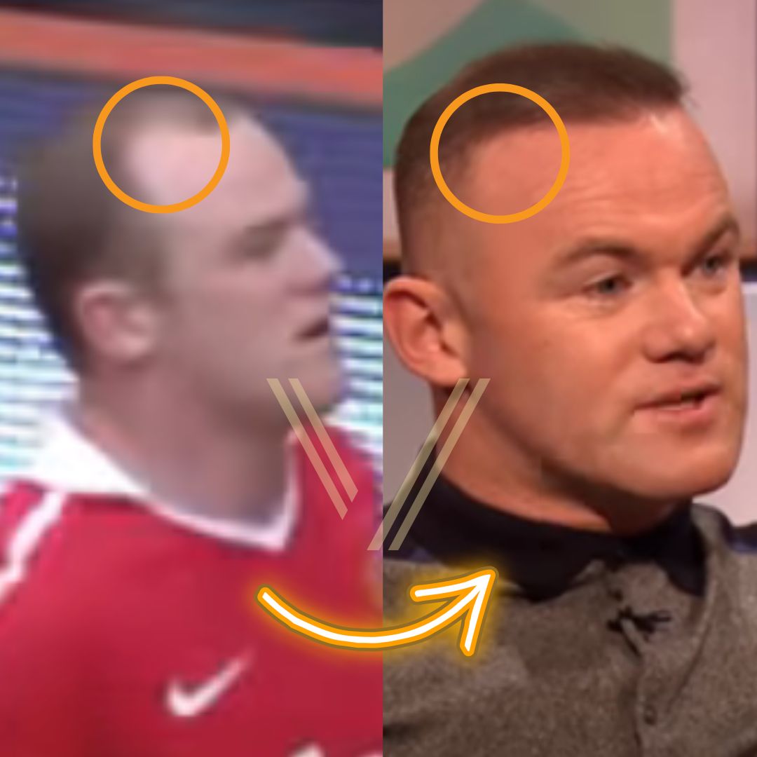 Wayne Rooney's Hair Transplant Before and After Transformation