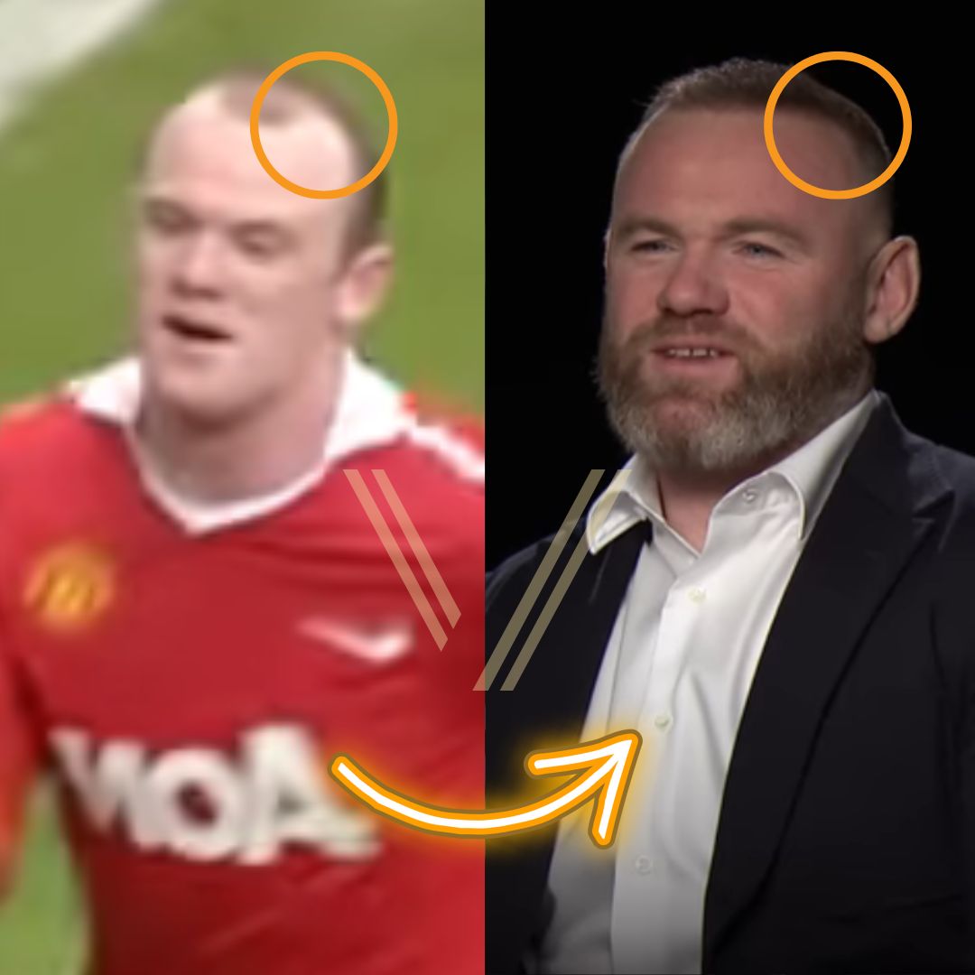 Wayne Rooney's Hair Transplant Before and After Transformation