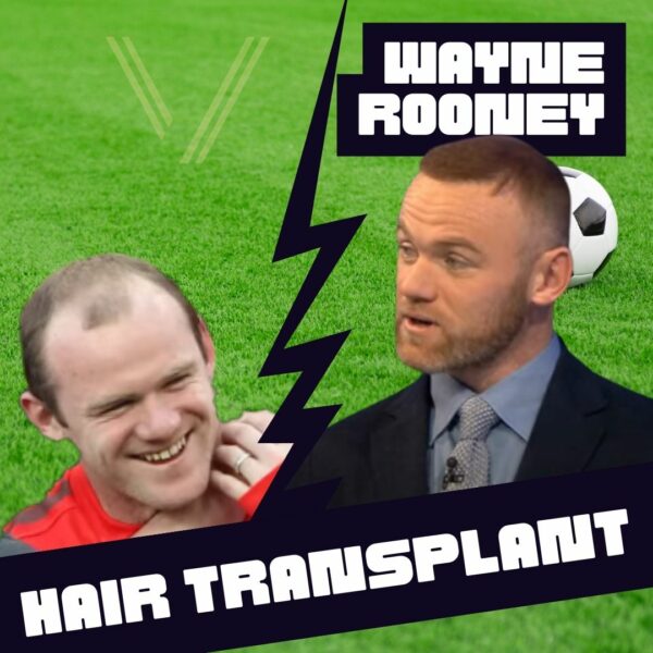 Wayne Rooney hair transplant