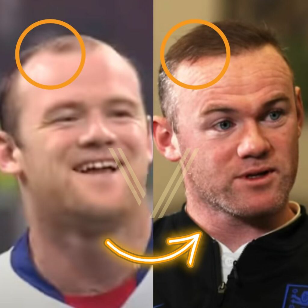 Wayne Rooney's Hair Transplant Before and After Transformation