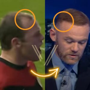 Wayne Rooney hair transplant result