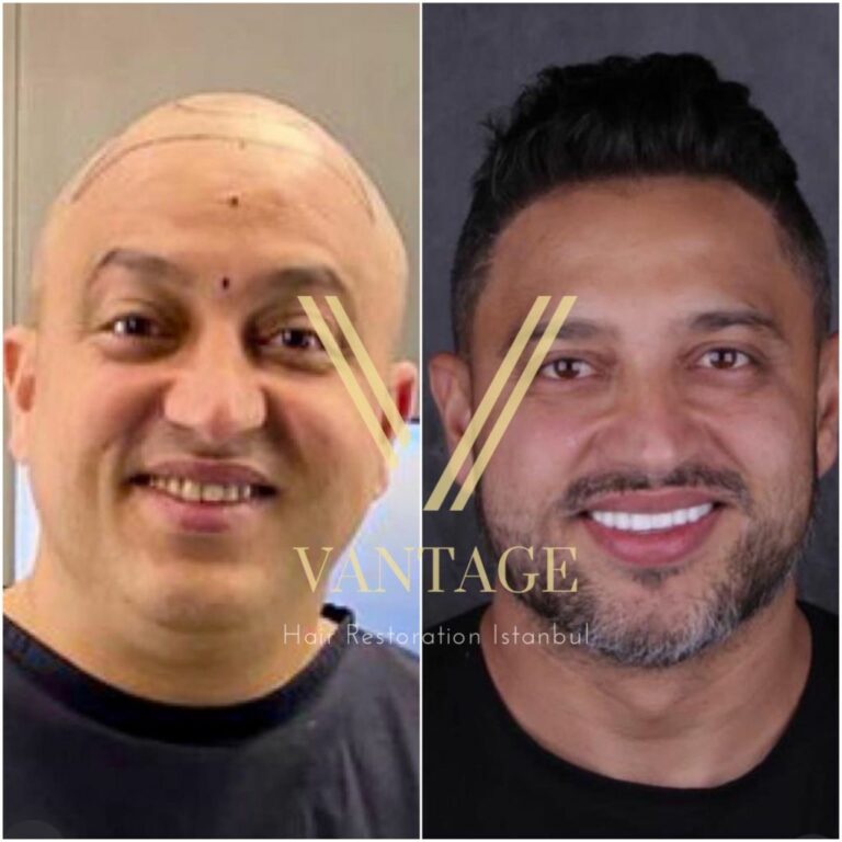 hair transplant 6000 grafts results before and after