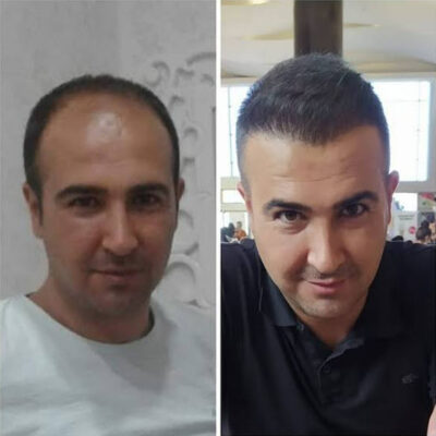 istanbul-hair-transplant-6000-grafts-before-after