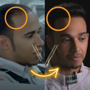lewis hamilton before after hair transplant