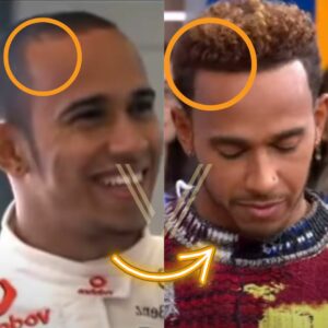 Lewis Hamilton’s Hair Transplant Before and After 
