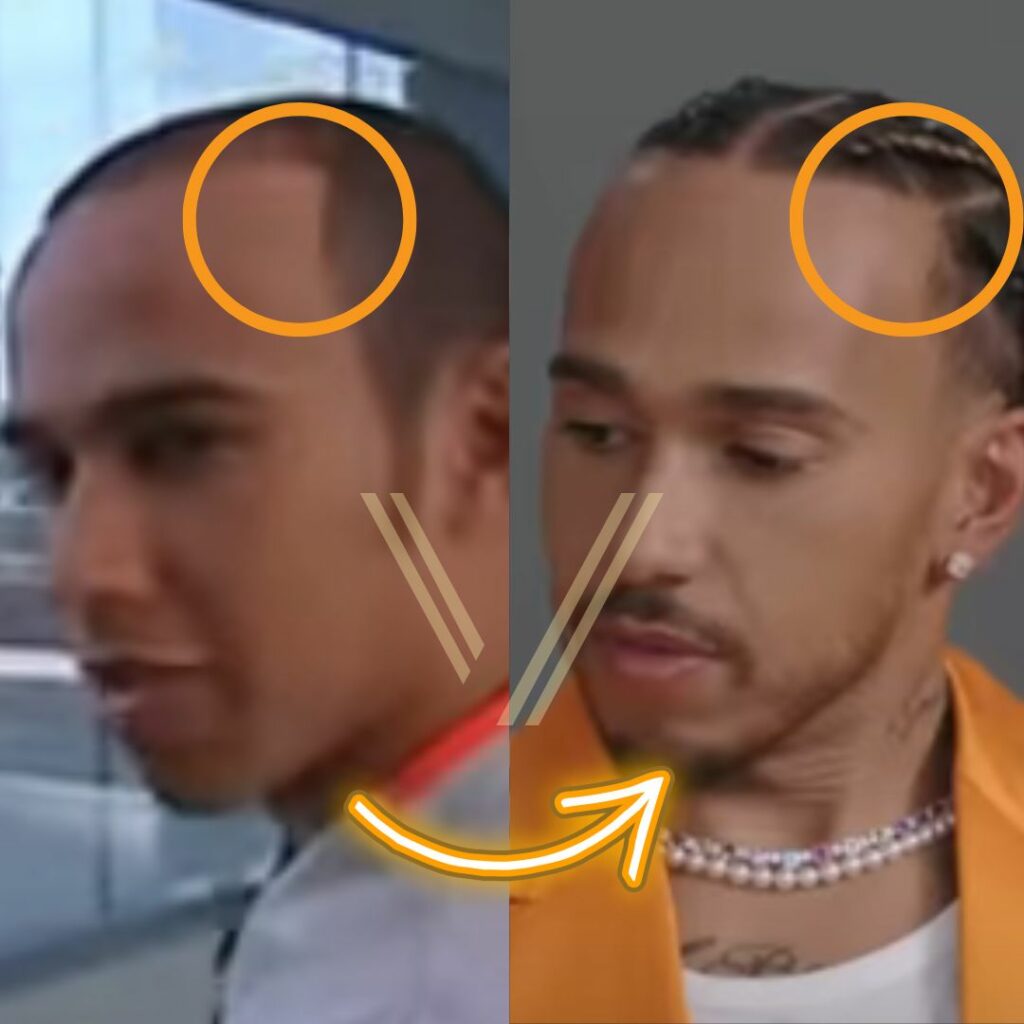 Lewis Hamilton S Hair Transplant Before And After Transformation