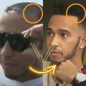lewis hamilton hair transplant before after photo