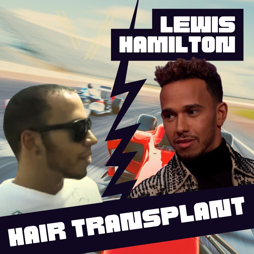 lewis hamilton hair transplant