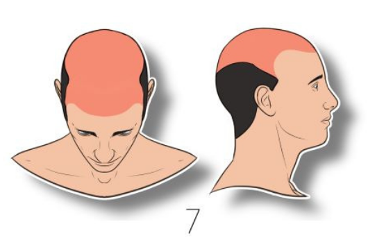 norwood hair loss scale step 7