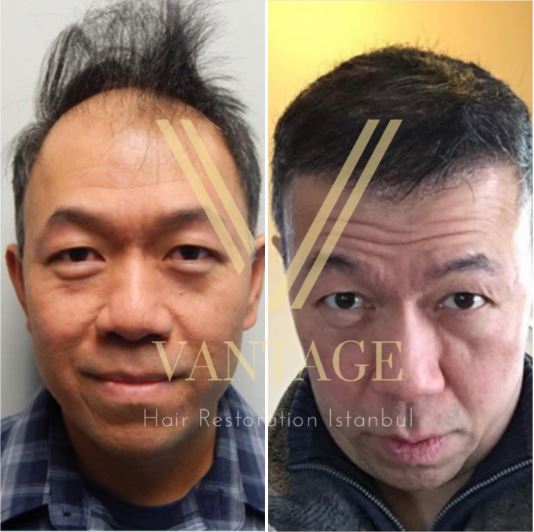 thin asian hair transplant before after result in turkey