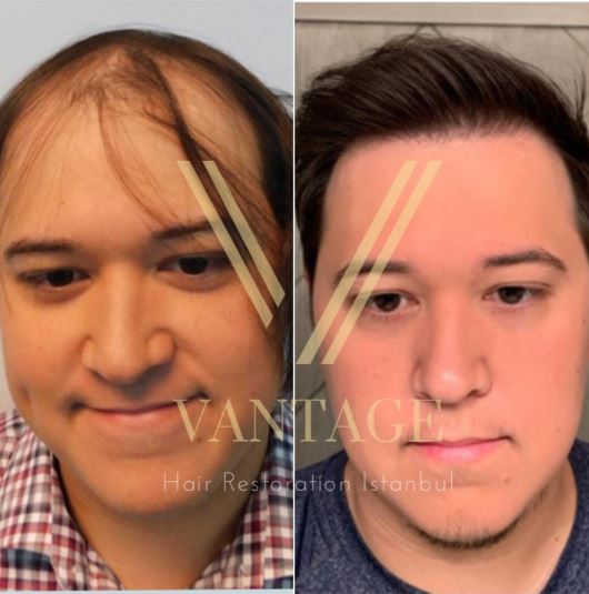thin hair transplant before after in turkey