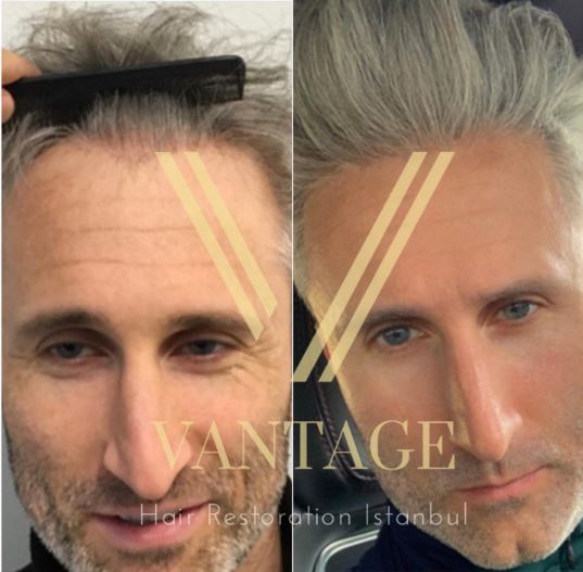 gray hair transplant before after in turkey