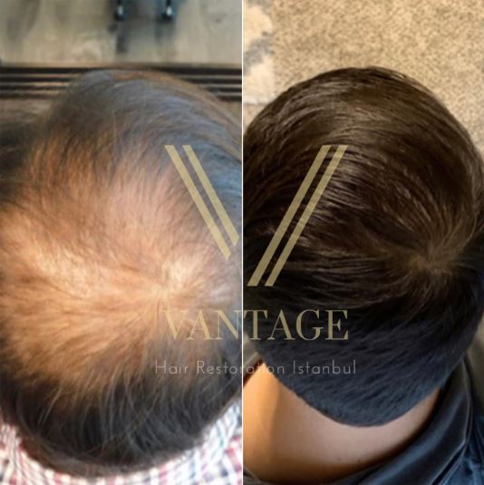 crown area hair transplant before after