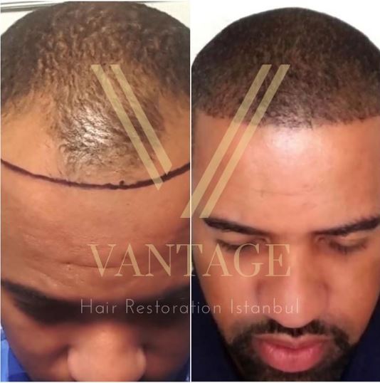 afro hair transplant before after in istanbul turkey