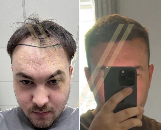 hairline transplant before after result in turkey