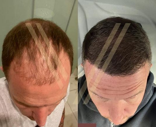hairline transplant in turkey before after result