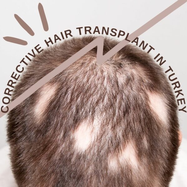 Corrective Hair Transplant in Turkey