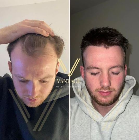 hair transplant result before after