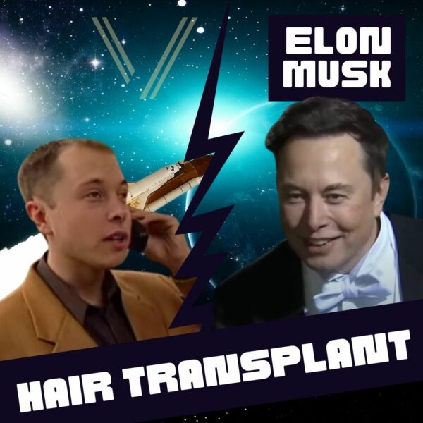 Elon Musk Hair Transplant: Before and After Transformation