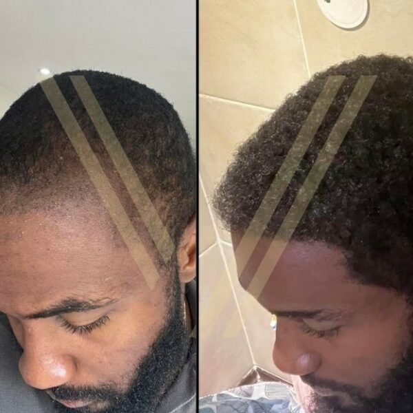 afro american hair transplant turkey before after result photo