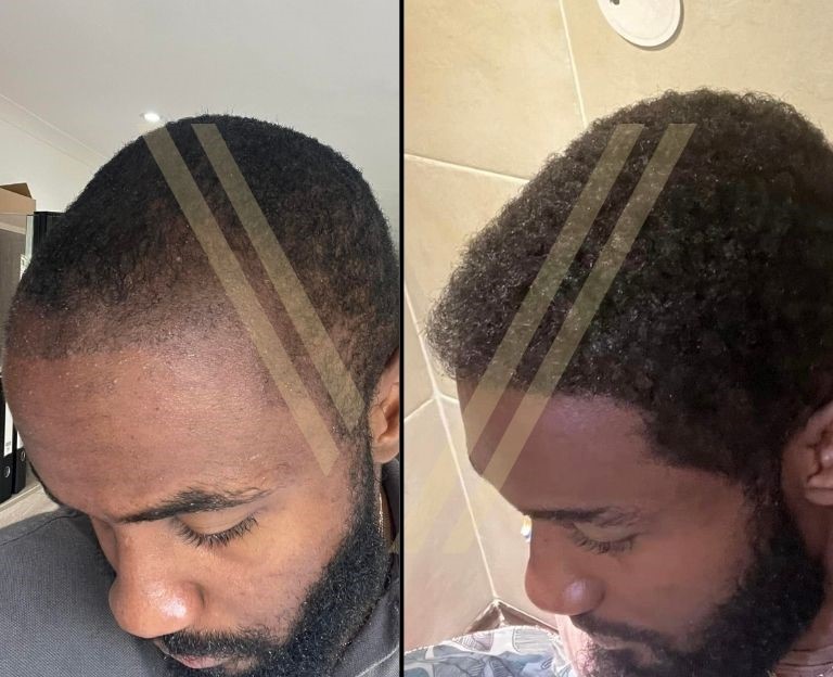 afro american hair transplant turkey before after result photo