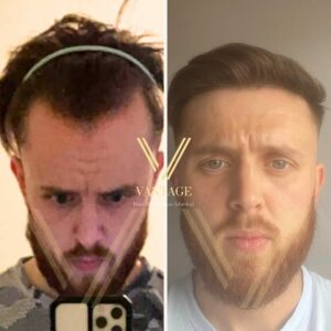 Before After Hairline Transplant result in Turkey